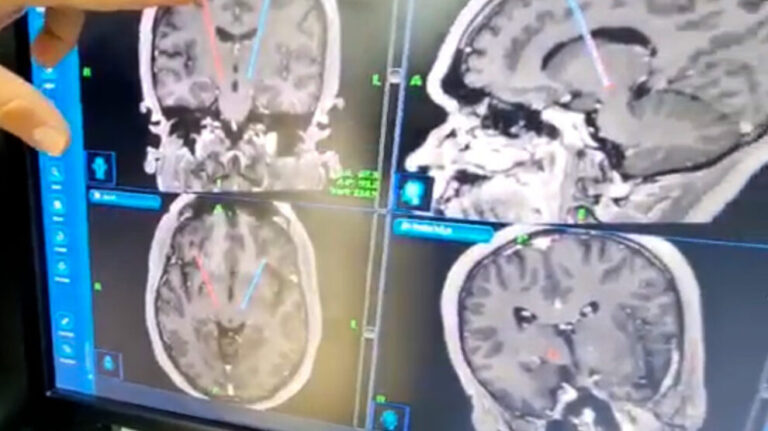 Sinop: 1ª cirurgia de estimulação cerebral profunda é feita em paciente com parkinson