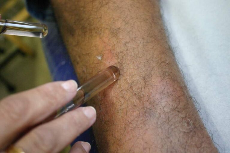 Governo abre 250 vagas para capacitação de profissionais da saúde em hanseníase