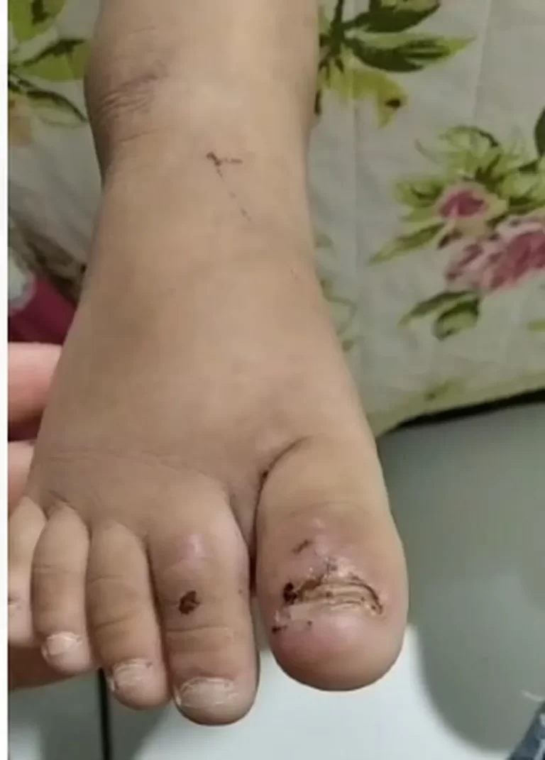 Padrasto suspeito de torturar menina de 6 anos com deficiência visual em MT é preso no Maranhão