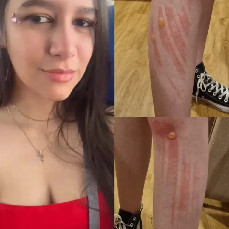 ‘Pior experiência que já tive na vida’, diz fã de MT que foi a show de Taylor Swift e teve queimaduras de 2° grau pelo corpo